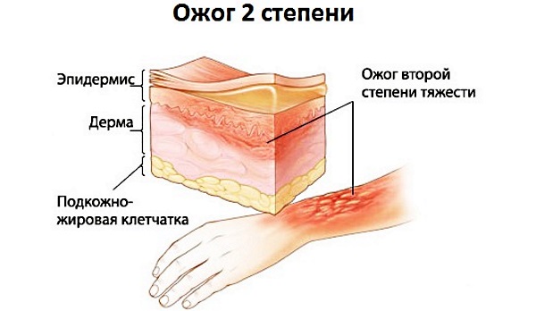 Лечение ожога кипятком, волдырей, мокнущей раны в домашних условиях. Народные средства, мази из аптеки